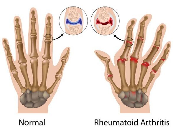 Patolojisiz ve romatoid artrit ile parmak eklemleri