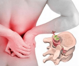 Hastalığın başlangıcında lumbago osteokondroz