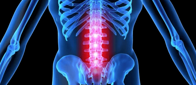 İntervertebral diskin deformasyonu