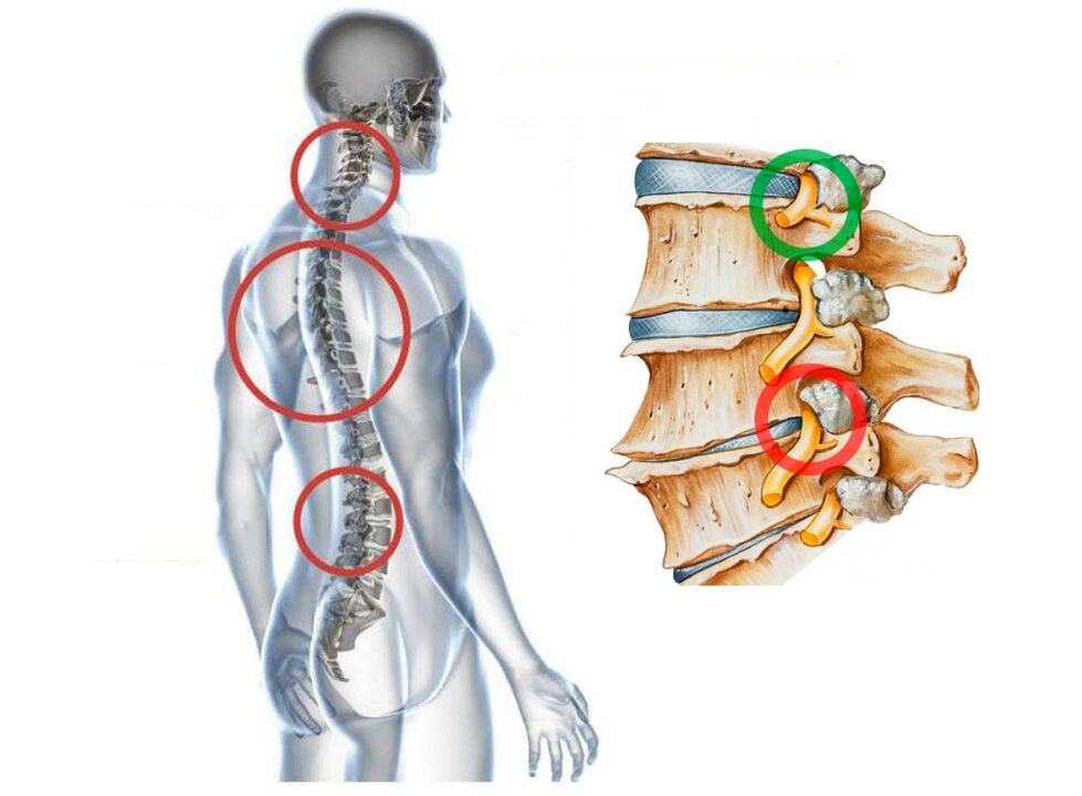 Omurların servikal osteokondrozu neye benziyor