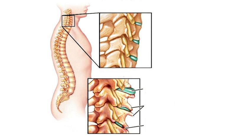 Osteokondroz sendromları