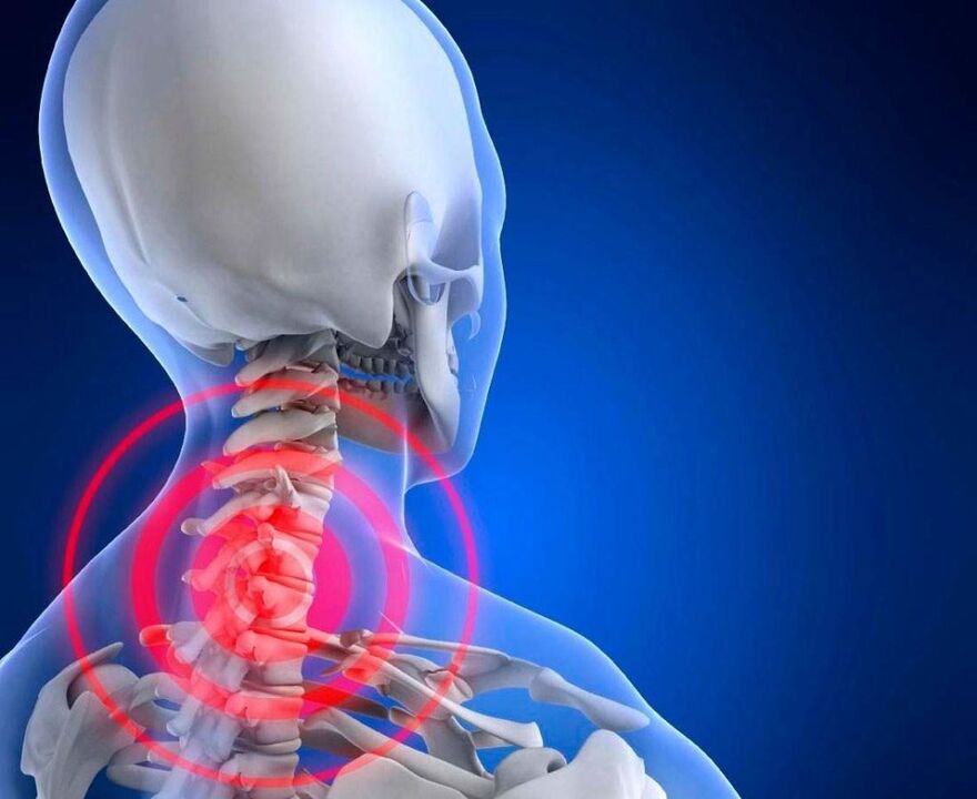 Servikal osteokondroz ile boyun ağrısı