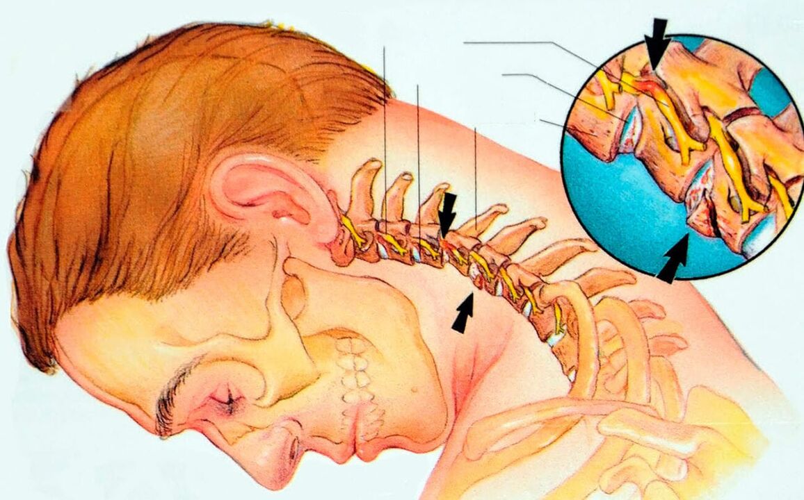Servikal osteokondroz nedir
