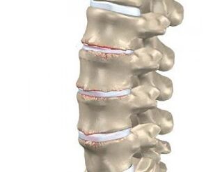 Spinal osteokondroz gelişimi