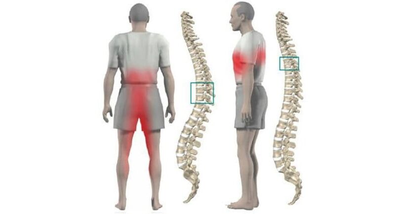 osteokondrozlu vücutta ve omurgada ağrı