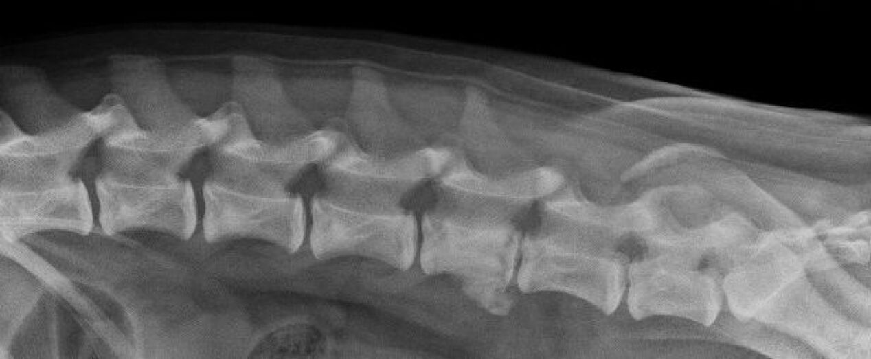Torasik omurganın osteokondrozunun röntgende belirtileri