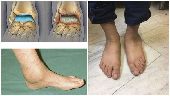 Artroz nedeniyle ayak bileği ekleminin şişmesi ve deformasyonu