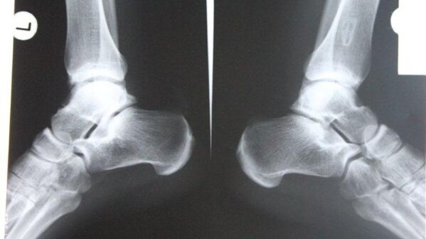 Radyografi kullanılarak ayak bileği artrozunun tanısı